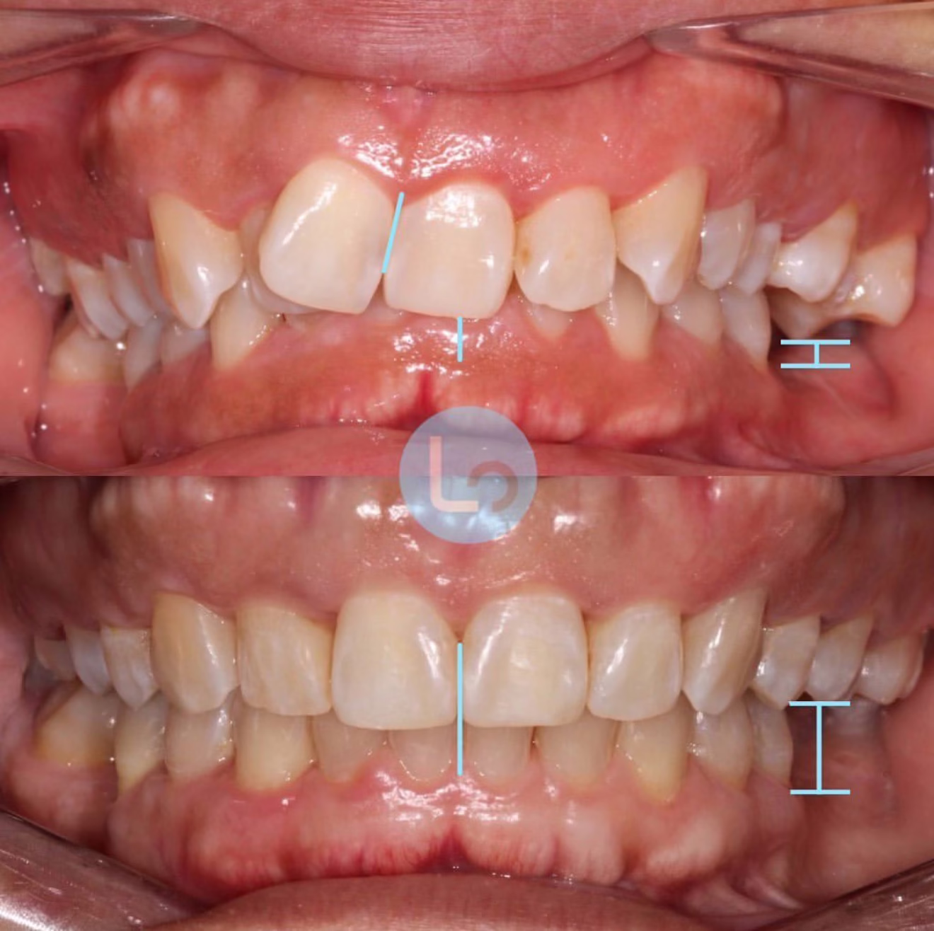 before and after