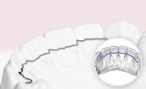 invisalign leesburg va