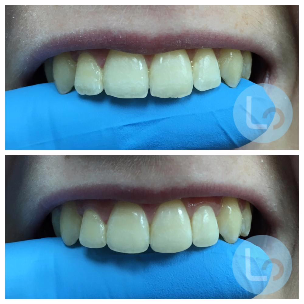 enameloplasty before and after
